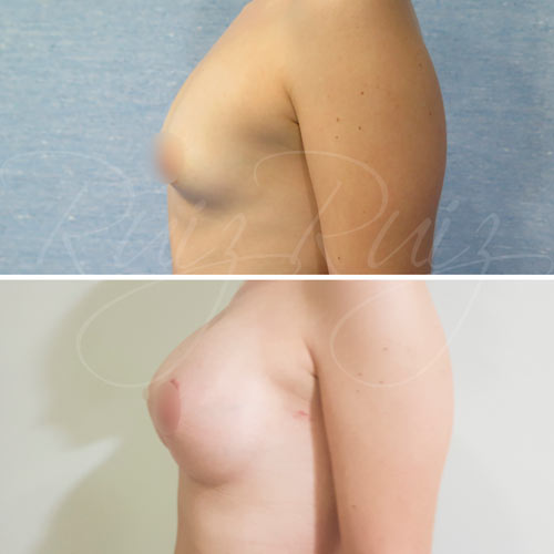 reconstruccion de pecho tras mastectomia malaga