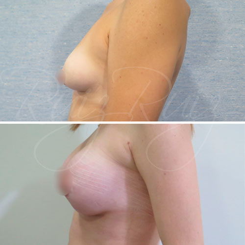 reconstruccion pecho mastectomia malaga