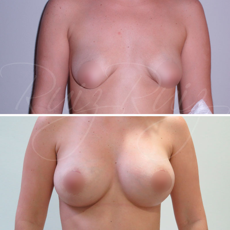 resultados operacion mamas tuberosas en malaga